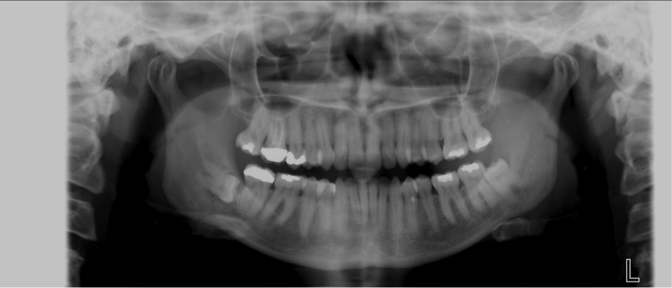 Case presentation: Discovery of cyst found using Planmeca extraoral bitewings