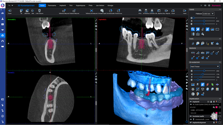 Case report: Guided implant surgery with Planmeca all-in-one solution