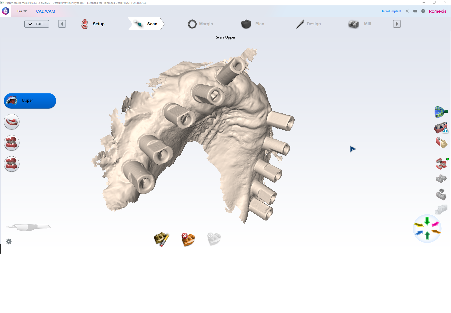 Can you use an intraoral scanner for upper jaw impressions