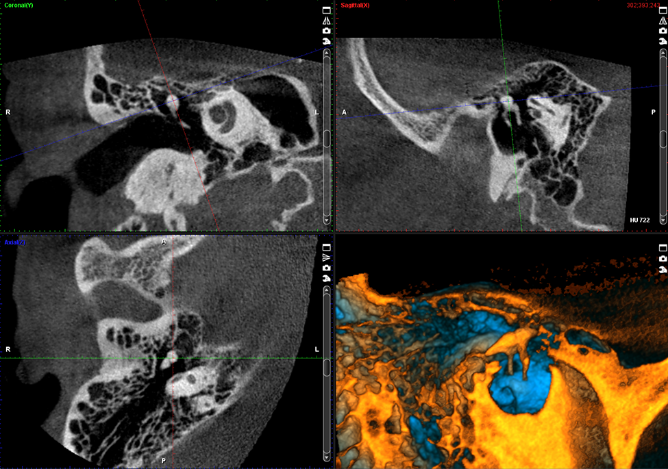 ProMax 3D Plus middle ear