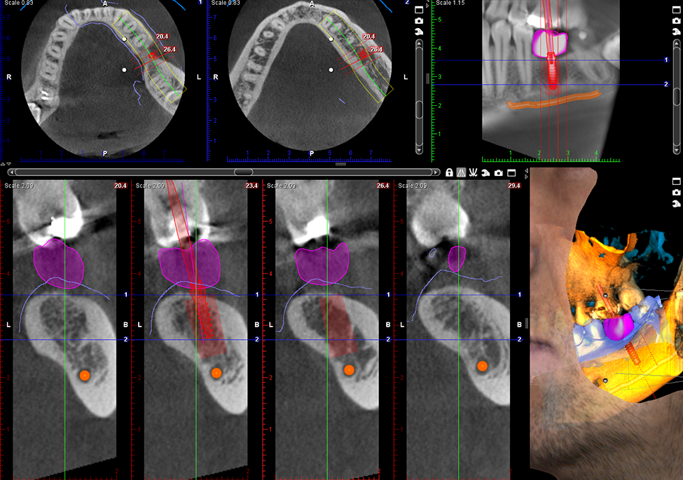 Planmeca ProMax 3D Classic – See the mandible and maxilla