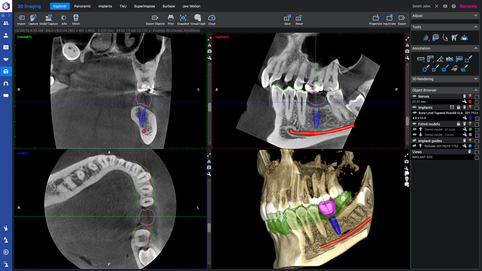 3D implantology software | Planmeca Romexis